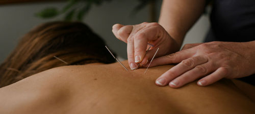 Acupuncture